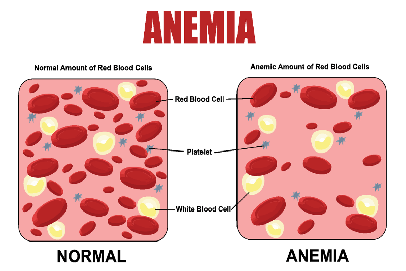 начини за лечение на анемия и причини