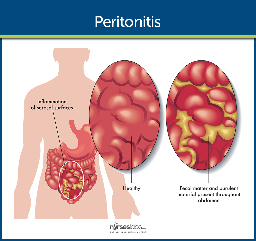 Перитонит: Причини, Симптоми и Лечение