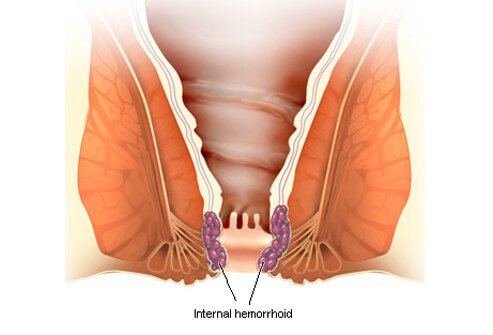 Хемороиди: Причини и лечение