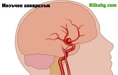 мозъчен аневризъм