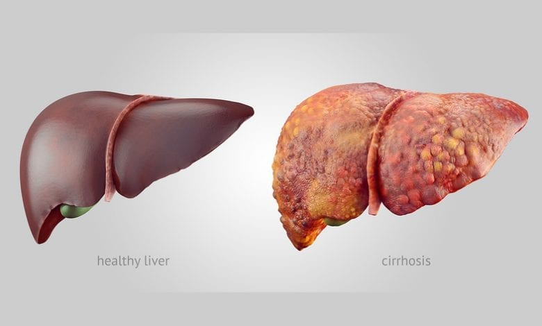Цироза - Симптоми, лечение и етапи