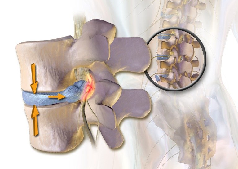подхлъзвани дискове и болки в гърба