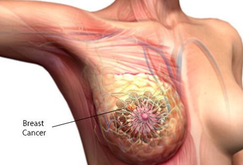 етапи-на-рак-на-гърдата