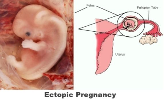 извънматочна-бременност-признаци