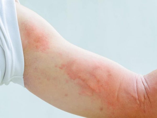 Алергия към Мухъл: 3 Издаващи Симптома ( +‎ Лечение )