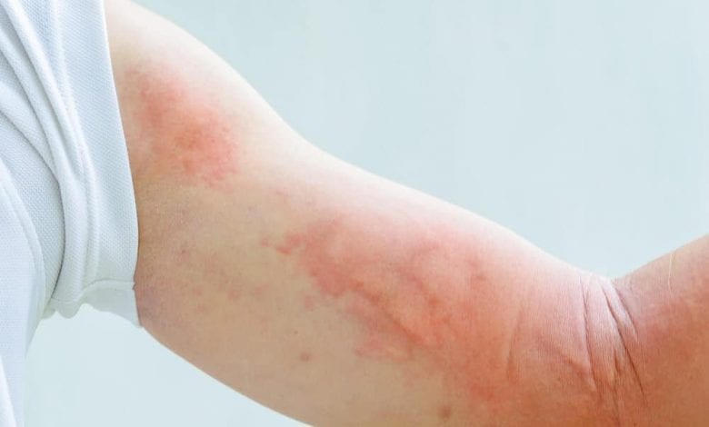 Алергия към плесен и мухъл