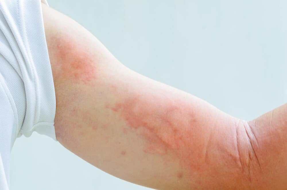 Алергия към плесен и мухъл