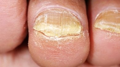 Лечение на Гъбички по ноктите: Лекарства и Бабени Илачи