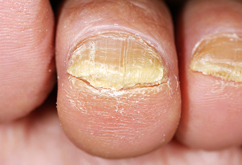 Лечение на Гъбички по ноктите: Лекарства и Бабени Илачи