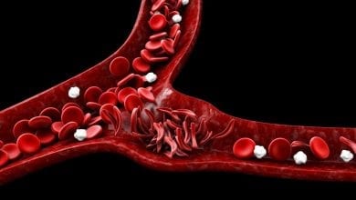 Сърповидно-клетъчна анемия - лечение, симптоми