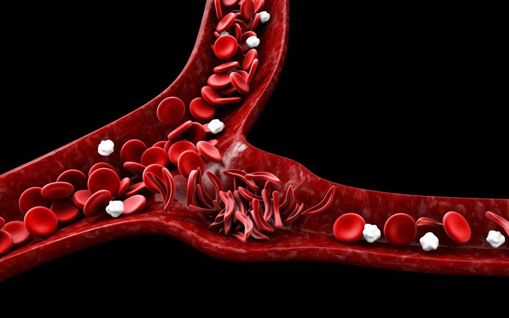 Сърповидно-клетъчна анемия - лечение, симптоми