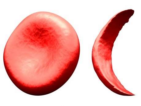 симптоми на Сърповидно-клетъчна анемия