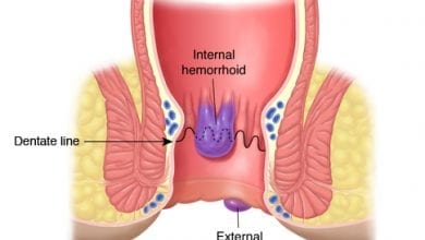 Външни хемороиди: 5 Лечения на Външни хемороиди
