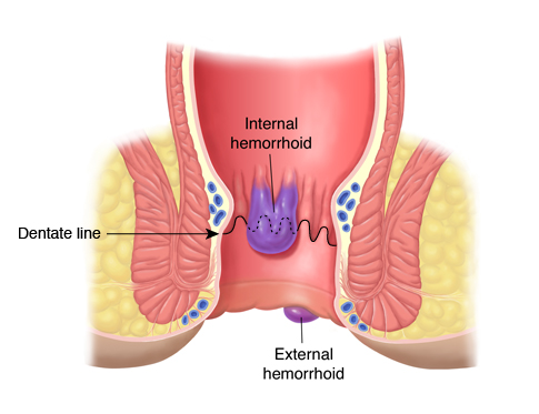 Външни хемороиди: 5 Лечения на Външни хемороиди