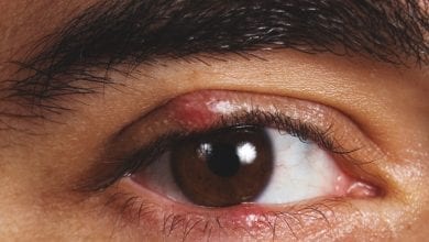 Ечемик на окото - 5 домашни средства за БЪРЗО лечение