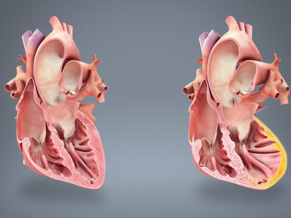 Как се разпознава инфаркта? 3 ранни Признаци и Симптоми