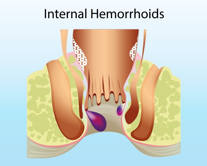симптоми на възпалени вътрешни хемороиди