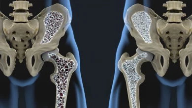 Остеопороза: Определение, причини, симптоми и лечение