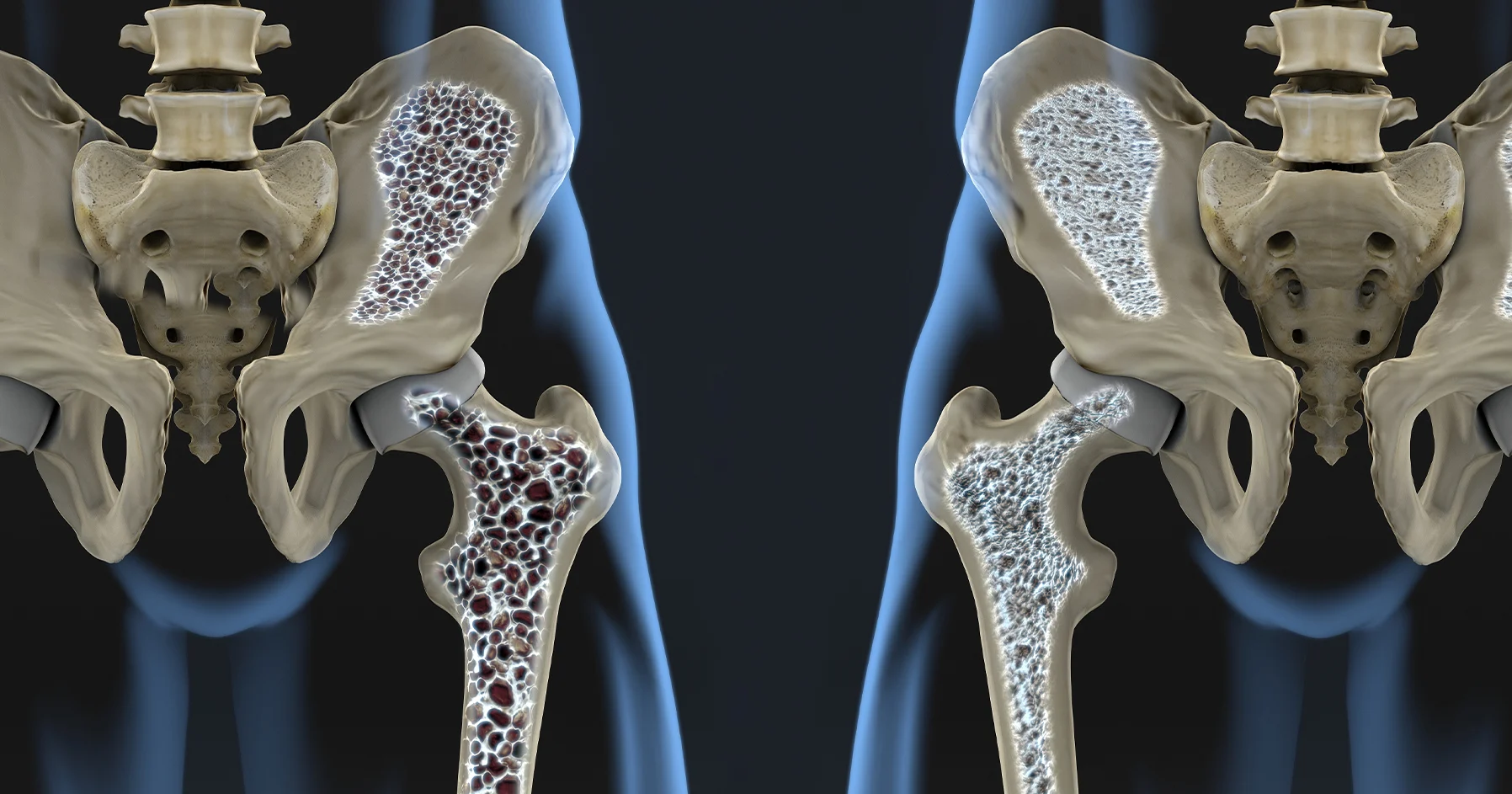 Остеопороза: Определение, причини, симптоми и лечение